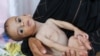 ISRAEL-PALESTINIANS/GAZA-HUNGER
