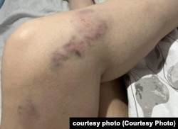 ავტობუსში მგზავრობისას მიღებული ტრავმა