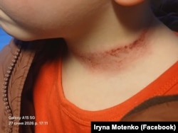 Сліди на шиї хлопчика