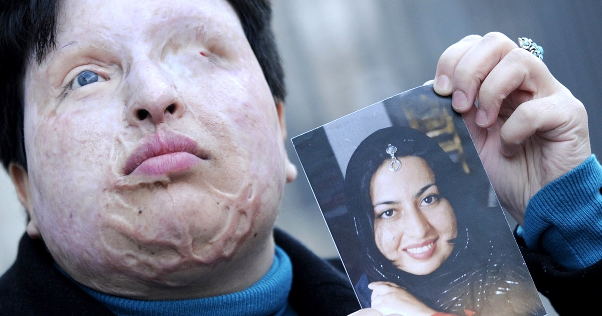 Disfigured Woman Hails 'Eye-For-An-Eye' Blinding Of Attacker In Iran