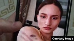 Фотография Айшат Баймурадовой со следами насилия
