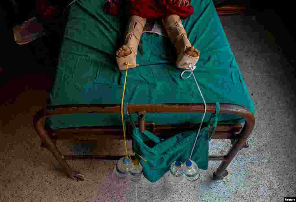 Ropes weighed down with water bottles are used to keep the legs of a girl in traction after she was injured in an earthquake. The picture was taken at a hospital in Kathmandu, Nepal, on April 29, 2015. (Reuters/Danish Siddiqui)