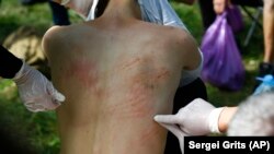 Мужчына паказвае сьляды зьбіцьця пасьля вызваленьня з ізалятару ў Менску 14 жніўня 2020