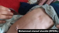 په رزګان کې په خوارځواکي اخته ماشوم- ارشیف