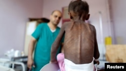 A medical worker examines a malnourished girl at a treatment center Yemen. (file photo)