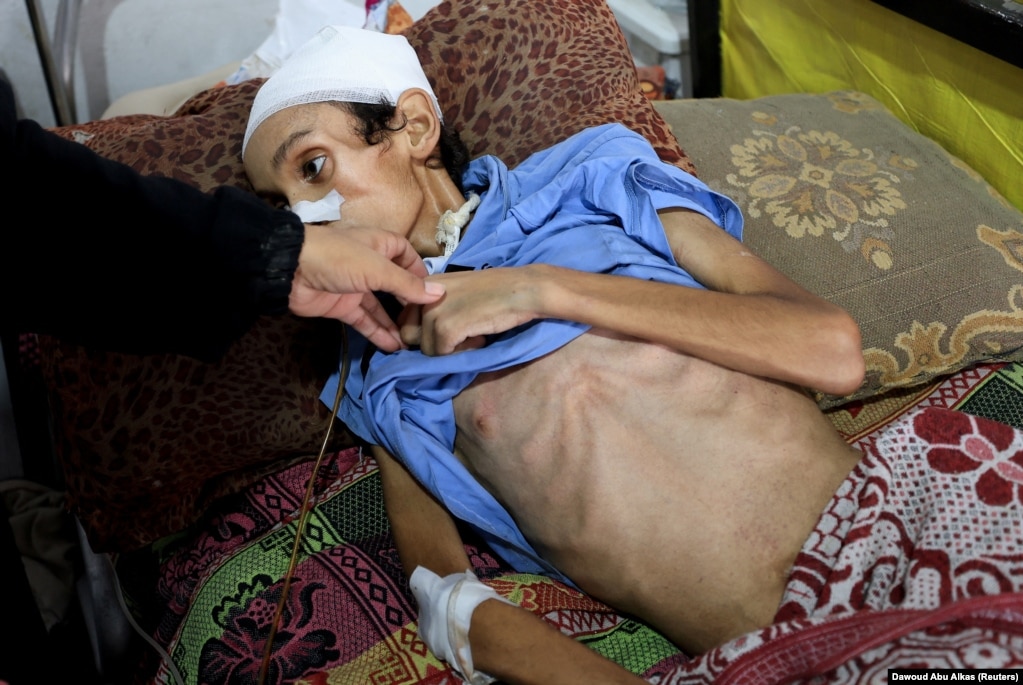 Mosab Al-Debs, djalë palestinez, 14-vjeçar, që vuan nga kequshqyerja, sipas mjekëve, duke u trajtuar në spitalin Shifa, më 22 korrik.