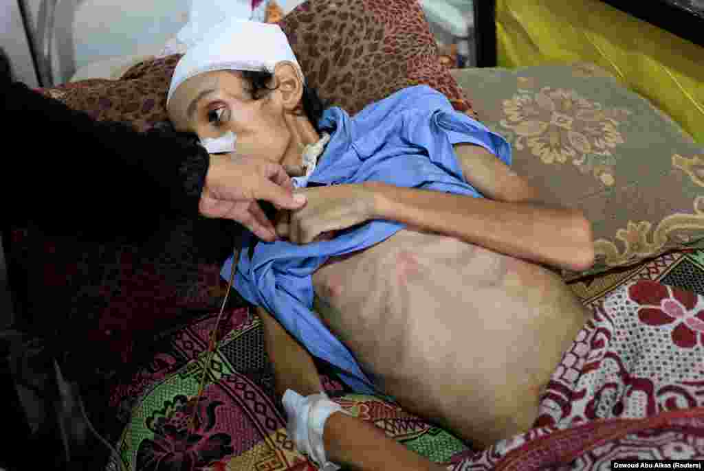 Mosab Al-Debs, djalë palestinez, 14-vjeçar, që vuan nga kequshqyerja, sipas mjekëve, duke u trajtuar në spitalin Shifa, më 22 korrik.