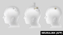 "Neuralink" çipinin implantasiyasının müxtəlif mərhələlərinin rəsmi