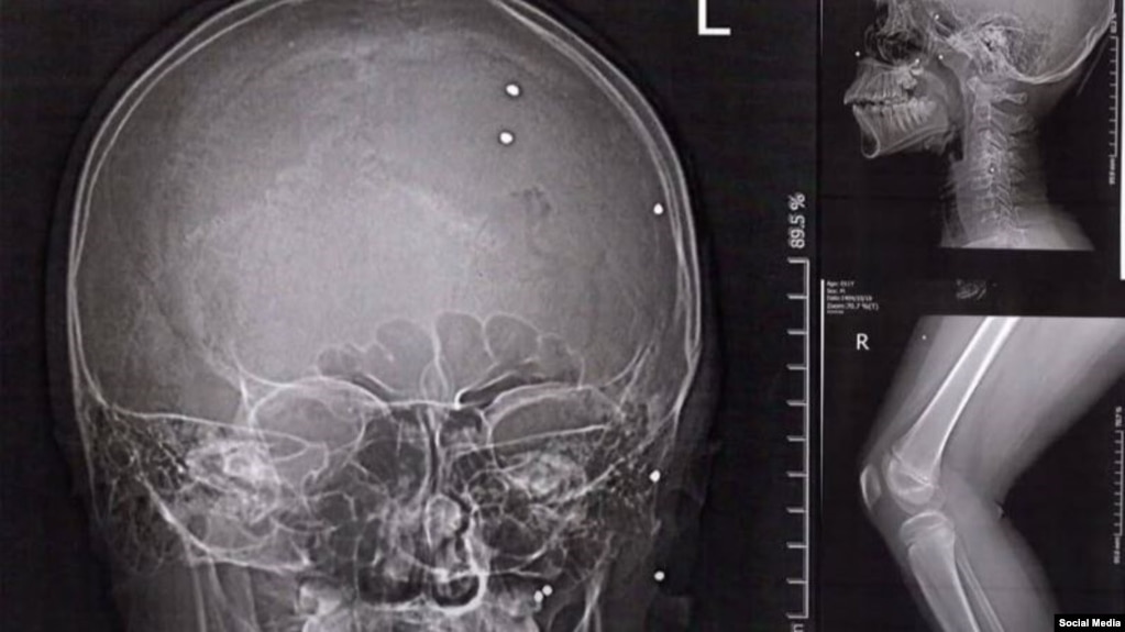 عکس رادیولوژی سر یک کودک که در اعتراض&zwnj;های دی ماه هدف گلوله ساچمه&zwnj;ای قرار گرفت