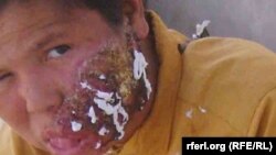 ارشیف: په لشمانیا ناروغۍ اخته افغان ماشوم