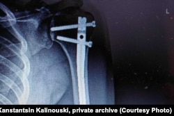 Здымак зламанай рукі Канстанціна Каліноўскага. Фота з прыватнага архіву