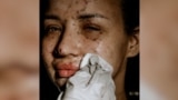 Ukrainian Woman Uses Pictures Of Injured Face To Raise War Funds