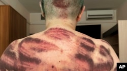 Елена Милашина показывает свою спину после нападения в Чечне. Июль 2023 года