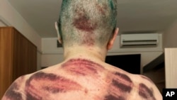 Отметины ног на спине Елены Милашиной после нападения в начале июля 