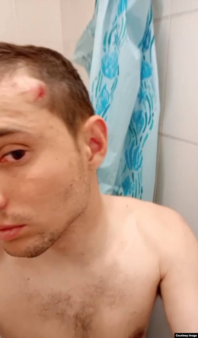 Артем Быков после очередного избиения сослуживцами