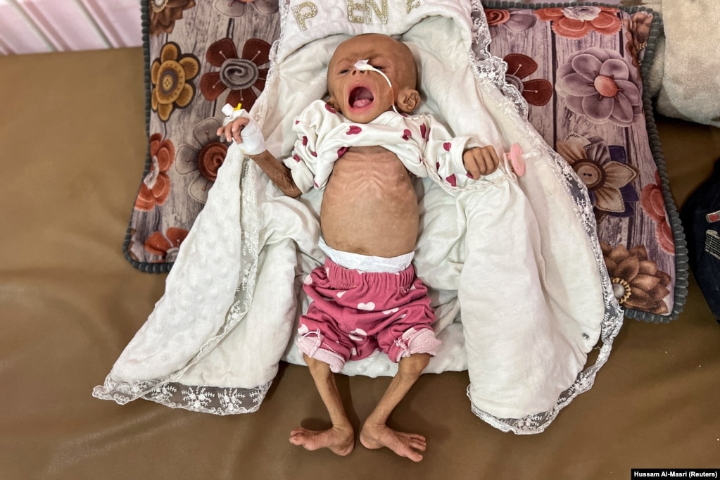 Zainab Abu Haleeb, vajzë pesëmuajshe palestineze, e diagnostikuar me kequshqyerje, sipas mjekëve, duke qëndruar në një shtrat teksa po trajtohej në spitalin Nasser, në Han Junis, në jug të Rripit të Gazës, më 15 korrik.