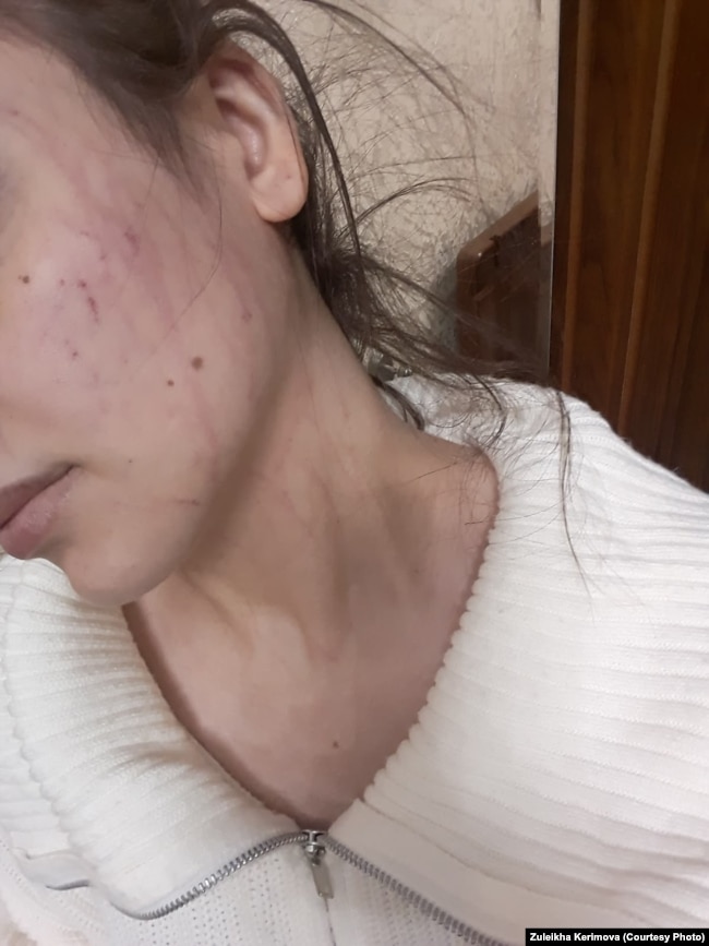 ზულეიხას თქმით, ეს ფოტო მისმა დამ, გარდაცვალებამდე რამდენიმე ხნით ადრე გამოუგზავნა და უთხრა, რომ დაზიანებები ბიძაშვილმა მიაყენა
